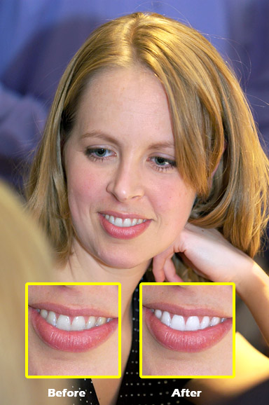A-Before-After
